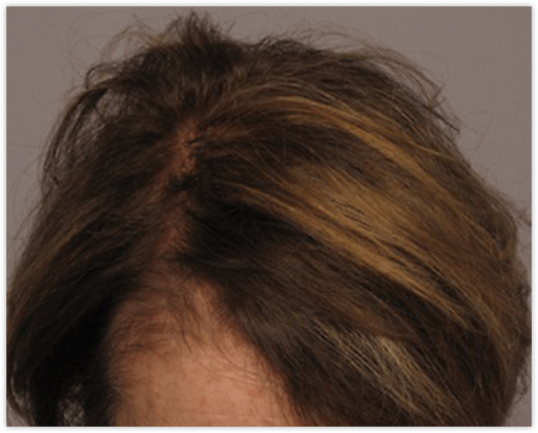 Female Patient After Neograft