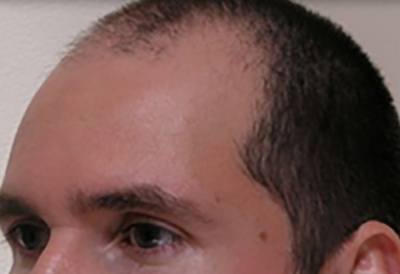 NeoGraft Patient Forehead Before Treatment