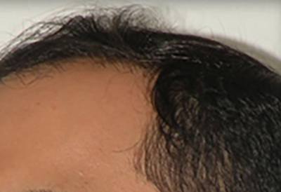 NeoGraft Patient Hairline Before Treatment