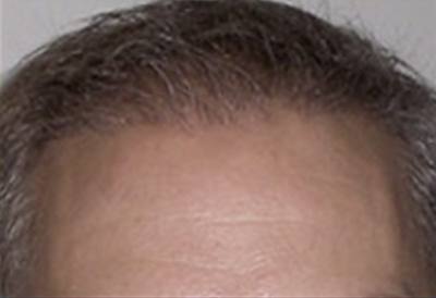 NeoGraft Patient Front Forehead After Treatment