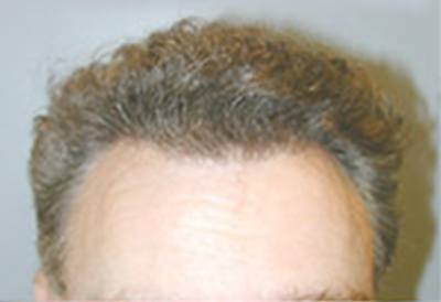 NeoGraft Patient After Treatment Lush Hair